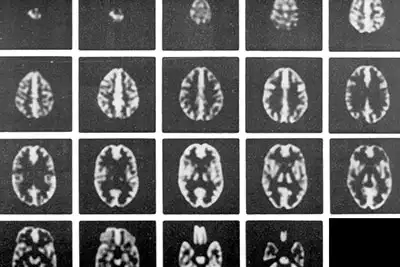 Hoffman 3D Brain Image